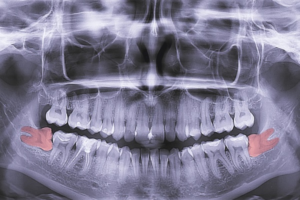 x-ray of teeth, molar tooth improperly growing, absence of the eighth molar