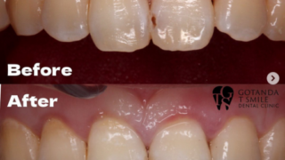 コンポジットレジン | 五反田駅5分の歯医者『五反田 T smile デンタル
